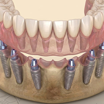 ALL ON 6 DENTAL IMPLANTS featured image
