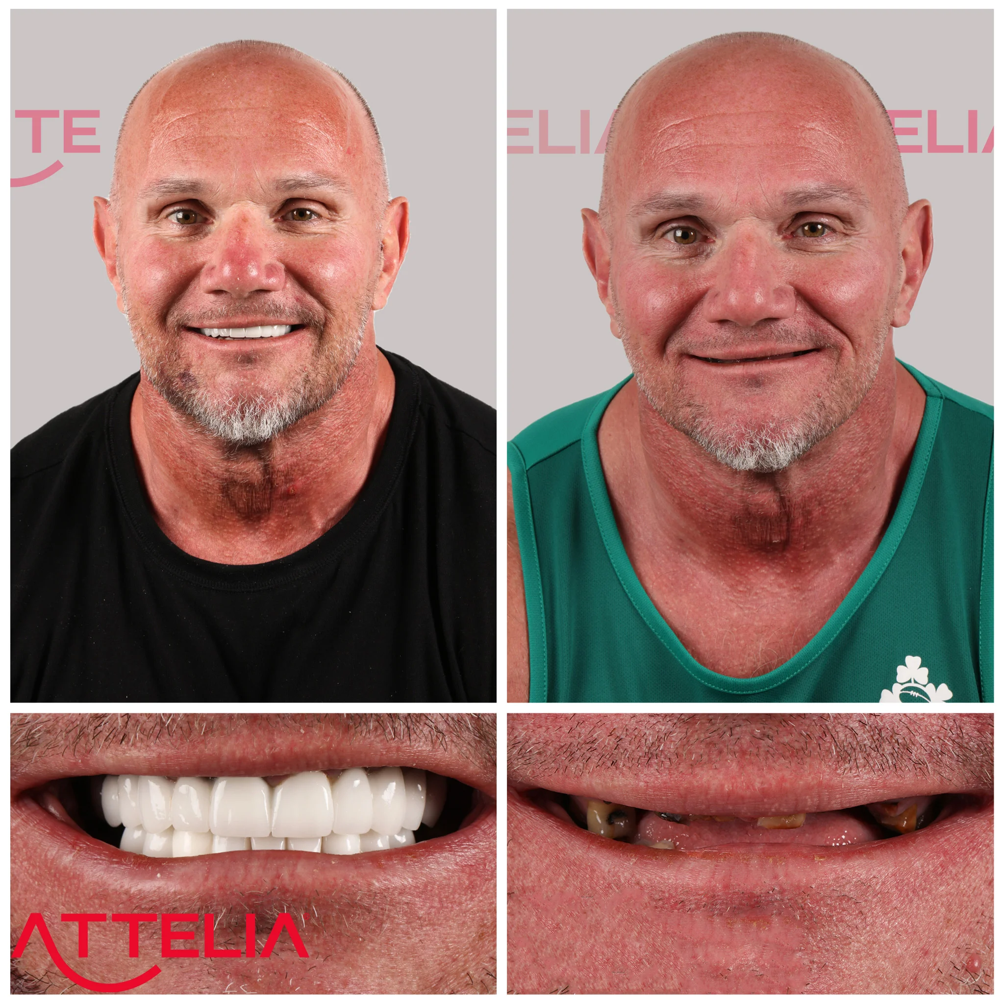 dental implants turkey