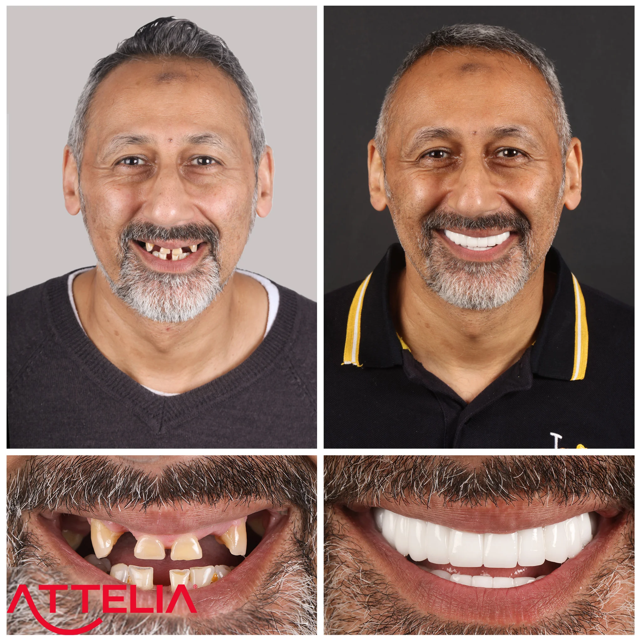 dental implants turkey