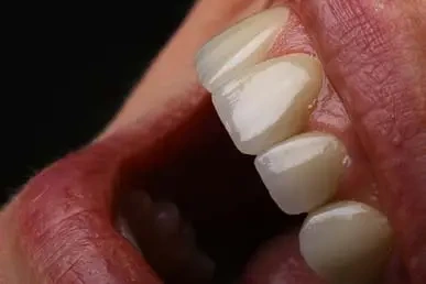 FACETTES DENTAIRES featured image