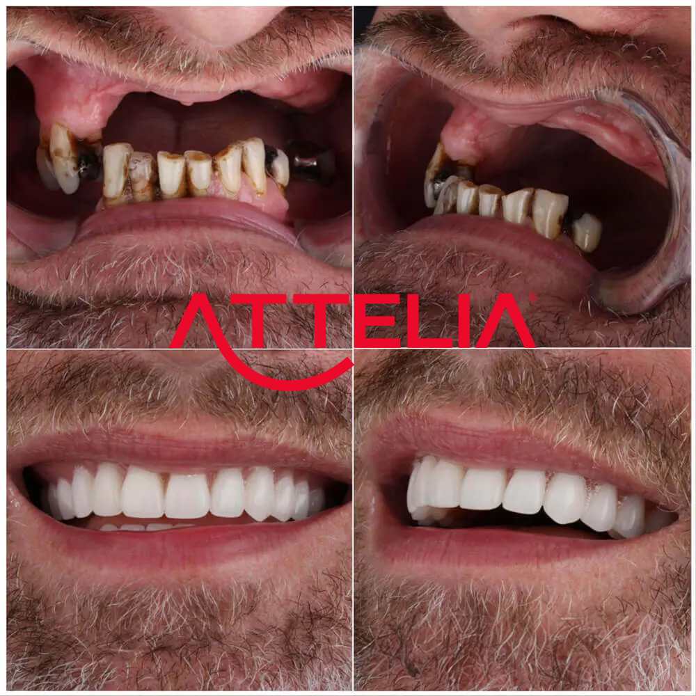 Facette Dentaires en Turquie  Attelia Dental Turquie - Clinique dentaire  primée et innovante à l'échelle mondiale à Antalya