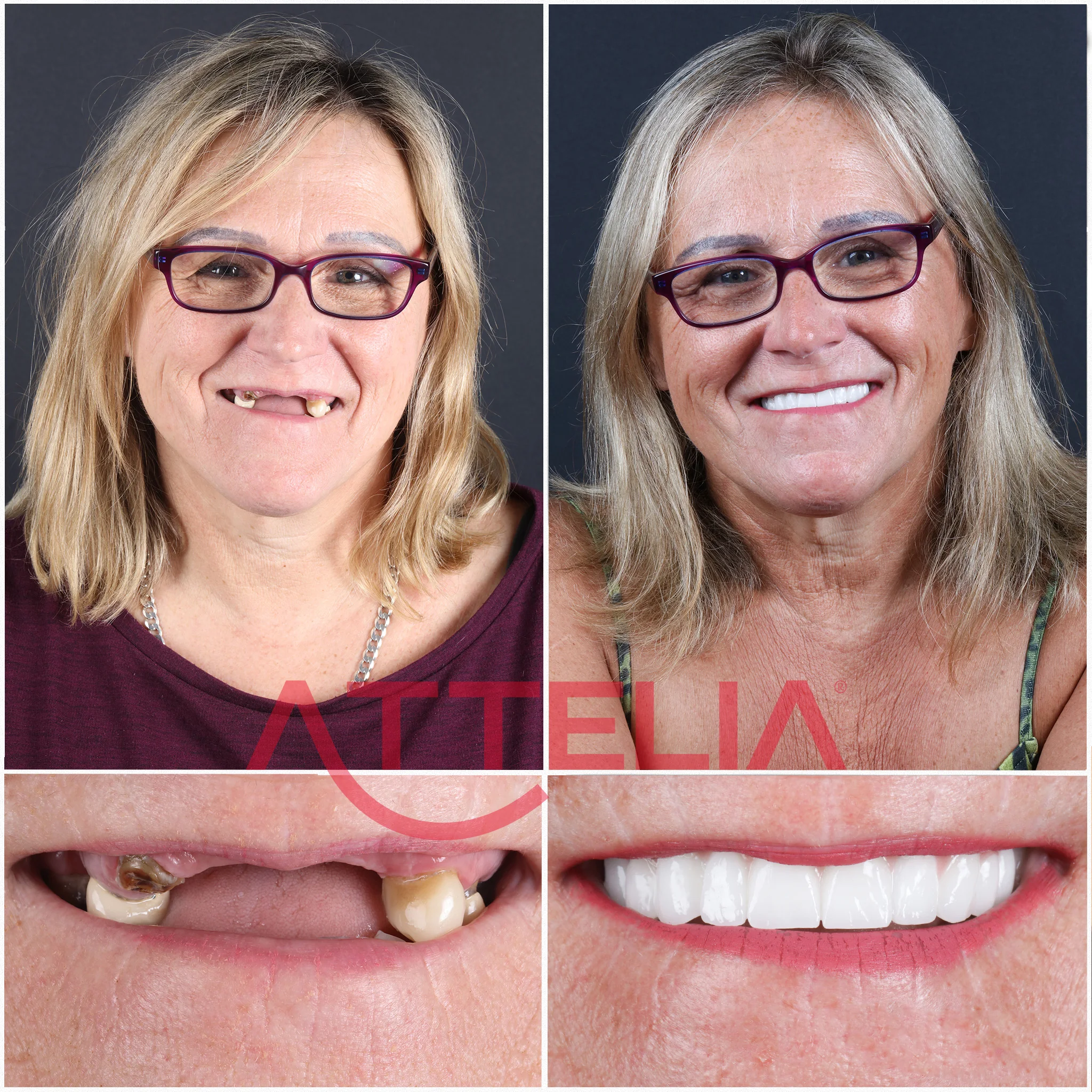 Implants dentaires mâchoire complète - Turquie, Dentiste
